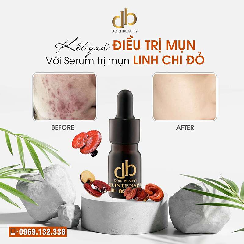 Hình Ảnh Kết Quả Trị Mụn Với Serum Linh Chi Đỏ DORI