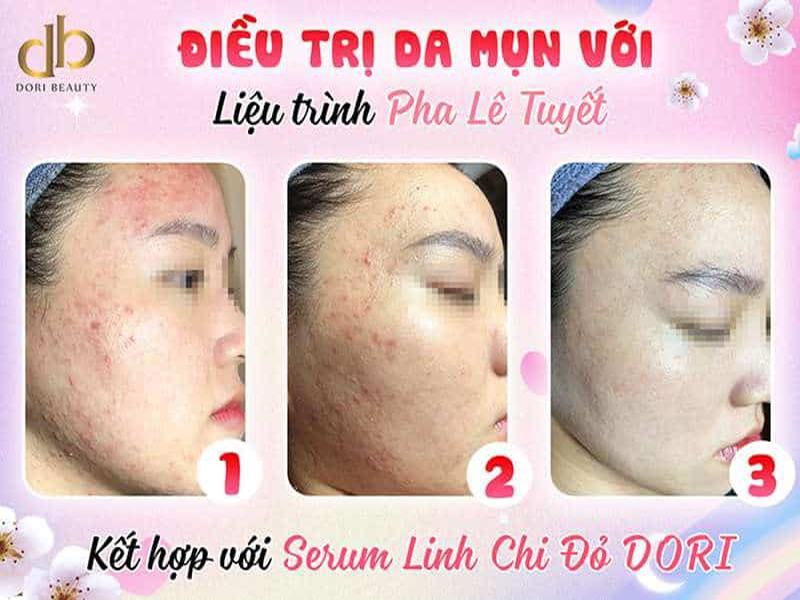 Kết Quả Trị Mụn: Liệu Trình Pha Lê Tuyết - Serum Linh Chi Đỏ