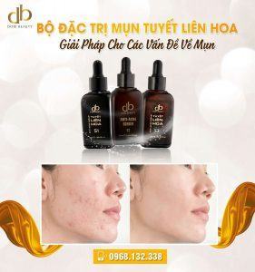 Bộ Đặc Trị Mụn Tuyết Liên Hoa: Giải Pháp Các Vấn Đề Về Mụn