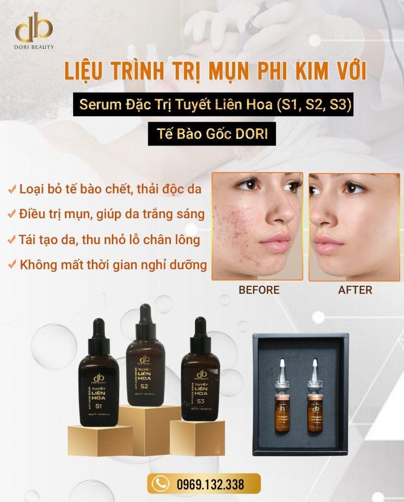 Liệu trình trị mụn phi kim tế bào gốc đặc trị chuẩn spa