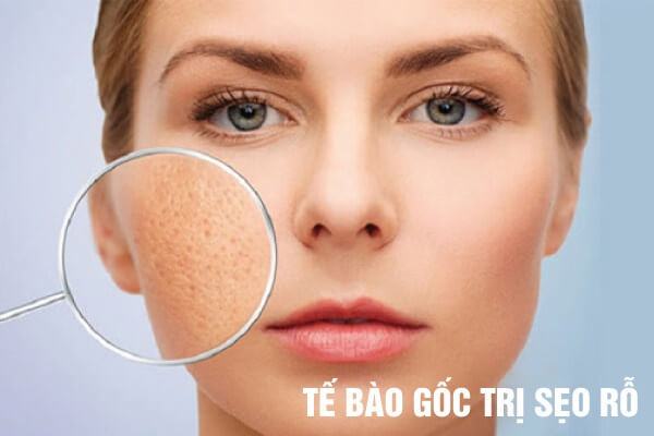 Tế bào gốc GSC trị sẹo rỗ hiệu quả