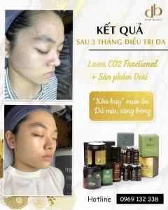 Điều trị da mụn