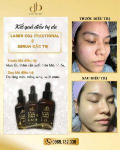 Điều trị da với Laser CO2 Fractional + Bộ Đặc Trị Mụn Tuyết Liên Hoa cho kết quả siêu đẹp.