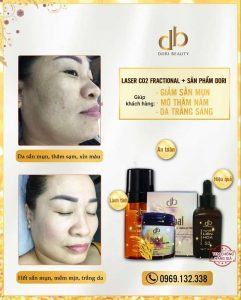 Điều trị da sần mụn - thâm nám