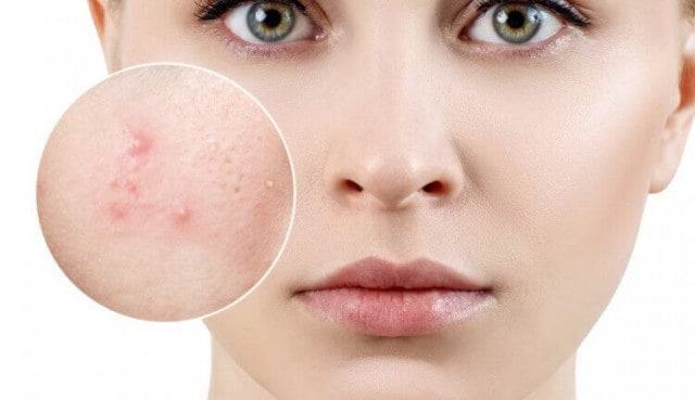 Trị mụn bằng kem yoosun