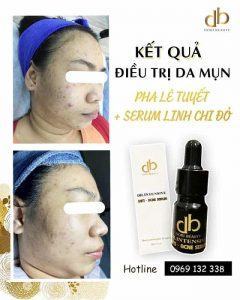 Trước & Sau Điều Trị Da Mụn Bằng Pha Lê Tuyết + Serum Linh Chi Đỏ