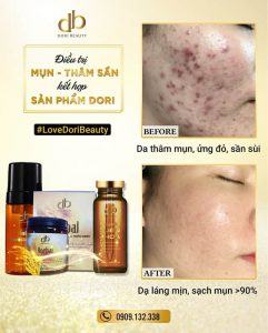 Kết quả điều trị da mụn - thâm nám