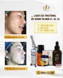 Công nghệ Laser CO2 Fractional kết hợp với serum đặc trị