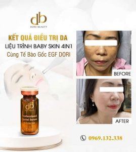 Trị nám bằng liệu trình baby skin 4in1
