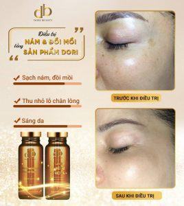 Kết quả điều trị nám