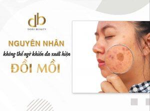 Nguyên nhân không thể ngờ gây nám