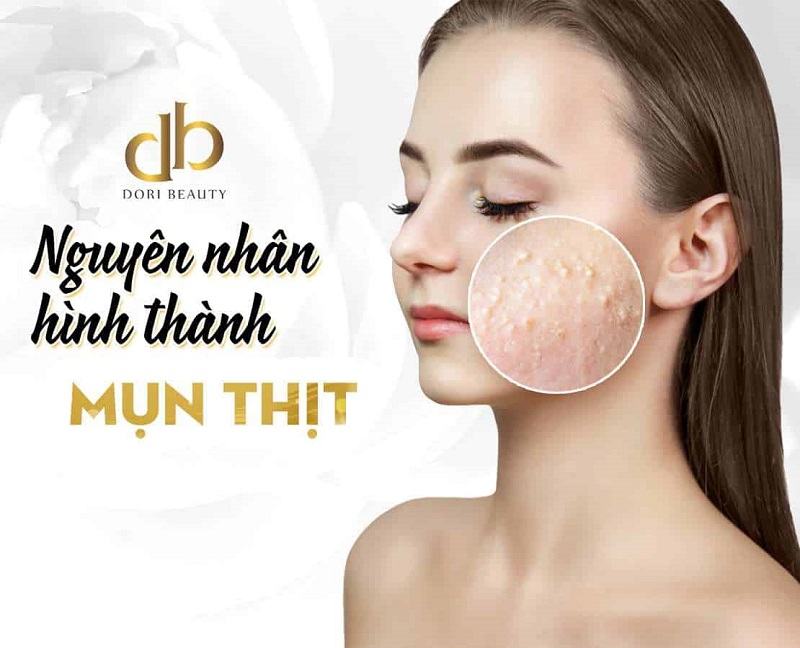 Nguyên nhân hình thành mụn thịt