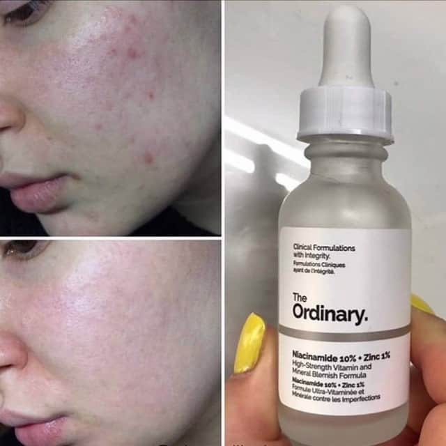 Serum trị mụn The Ordinary Tinh chất Niacinamide 10% + Zinc 1%