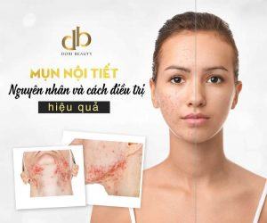 Nguyên nhân và cách điều trị mụn nội tiết