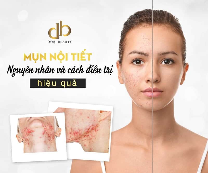 Nguyên nhân và cách điều trị mụn nội tiết