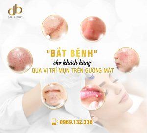 Nguyên nhân gây mụn vị trí trên mặt