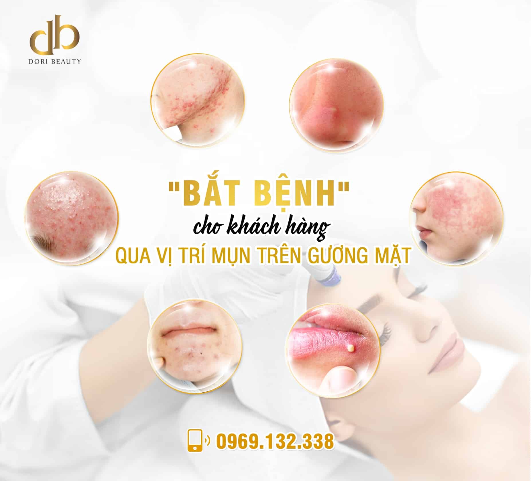 Nguyên nhân gây mụn vị trí trên mặt