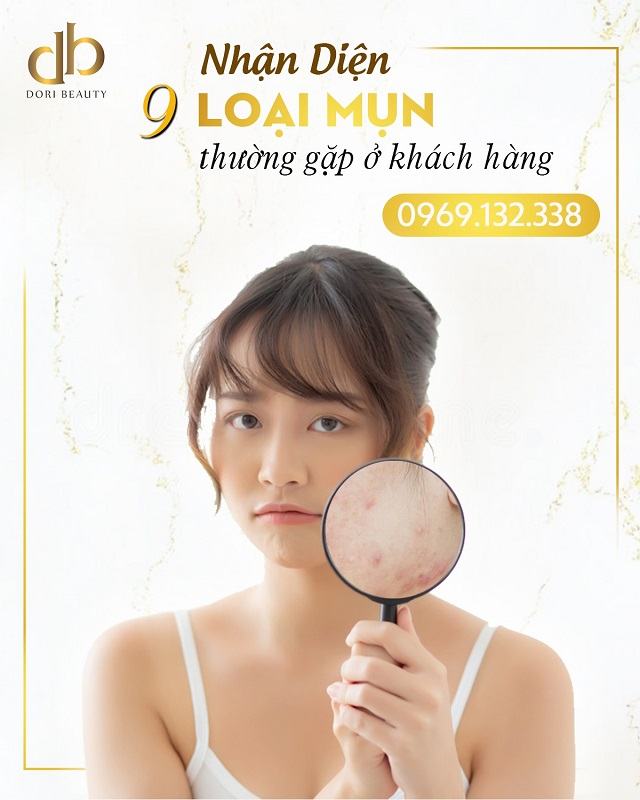 các loại mụn thường gặp nhất