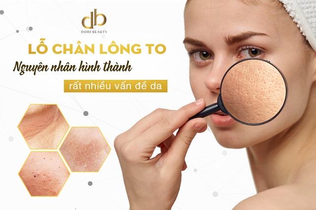 lỗ chân lông to