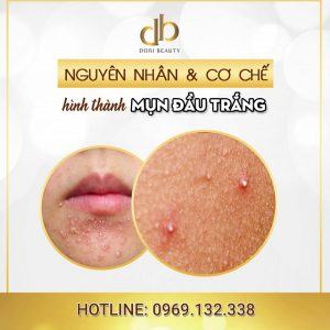 mụn đầu trắng là gì