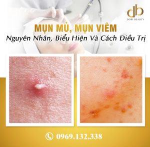 mụn mủ, mụn viêm là gì