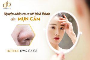 Nguyên nhân gây ra mụn cám