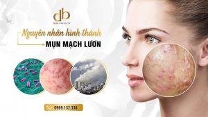 Nguyên nhân và cách điều trị mụn mạch lươn