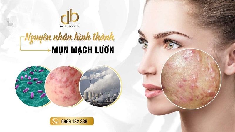 Nguyên nhân và cách điều trị mụn mạch lươn