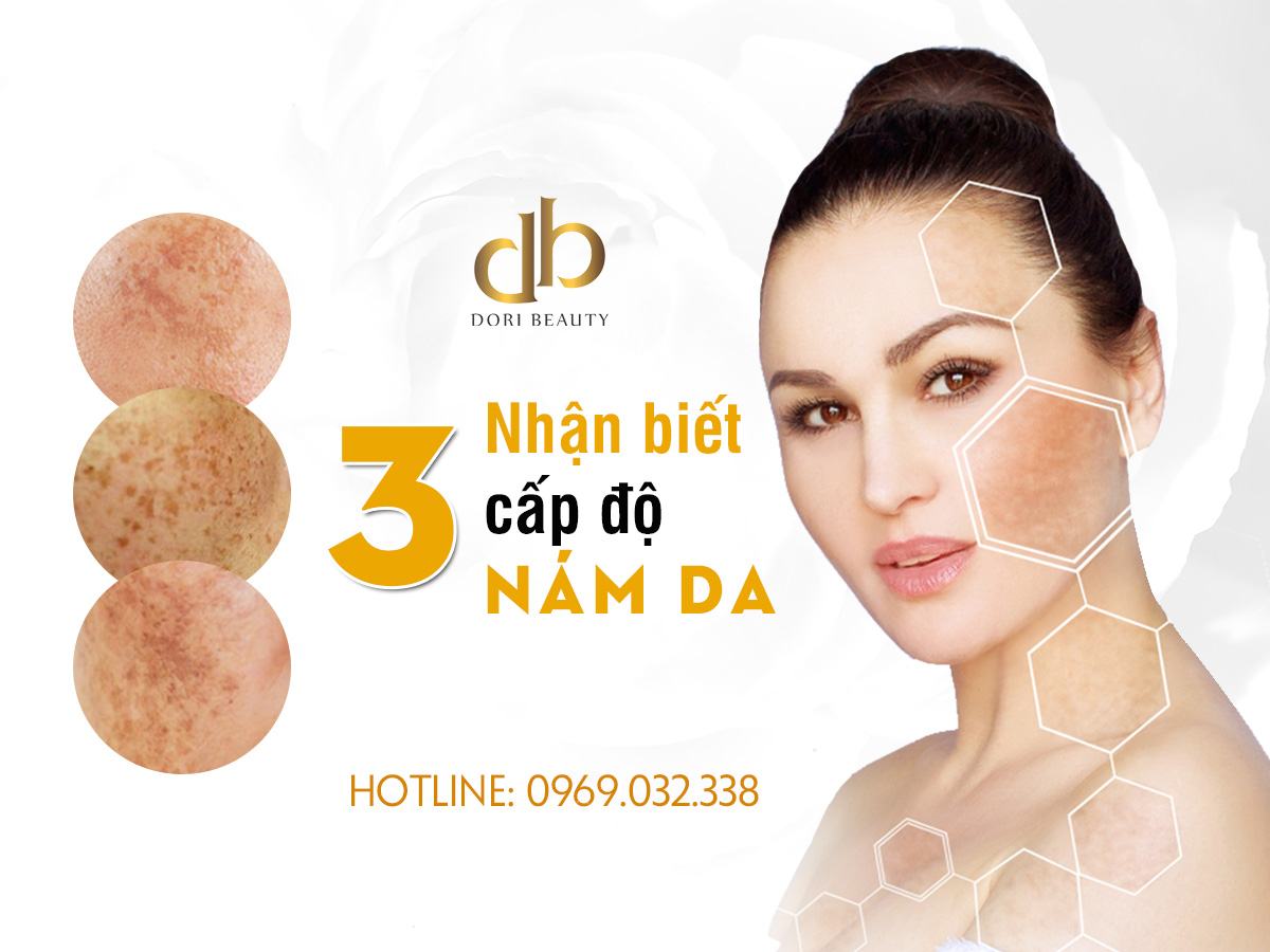 Các cấp độ nám da cơ bản