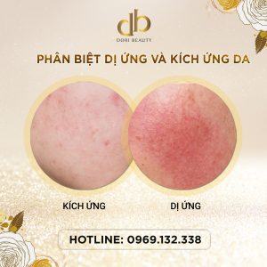 Phân biệt da bị dị ứng và kích ứng mỹ phẩm