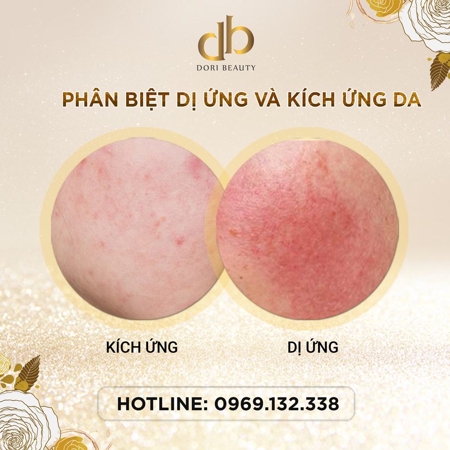 Phân biệt dị ứng và kích ứng da khi sử dụng mỹ phẩm