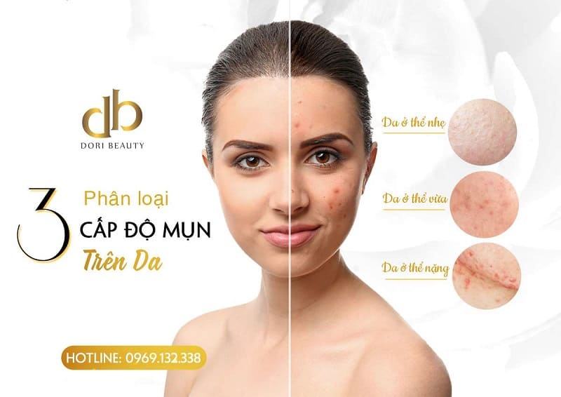 Phân loại 3 cấp độ mụn