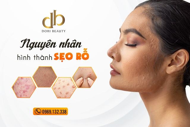 sẹo rỗ là gì