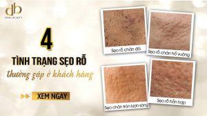 tình trạng sẹo rỗ thường gặp