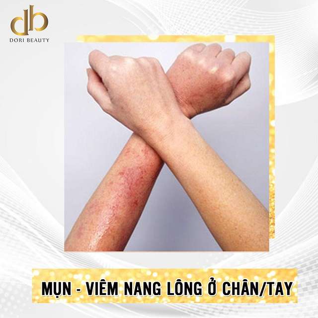 vị trí mụn viêm nang lông thường gặp