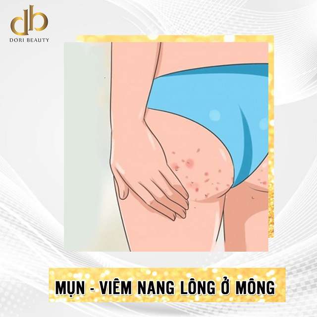 mụn viêm nang lông thường xuất hiện ở đâu