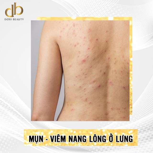 tình trạng mụn viêm nang lông trên cơ thể