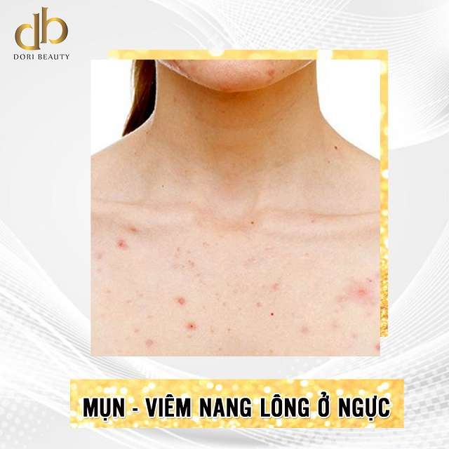 điều trị mụn viêm nang lông