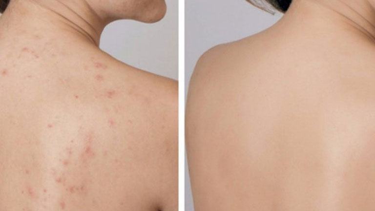 địa chỉ trị mụn lưng ở Long An tốt uy tín