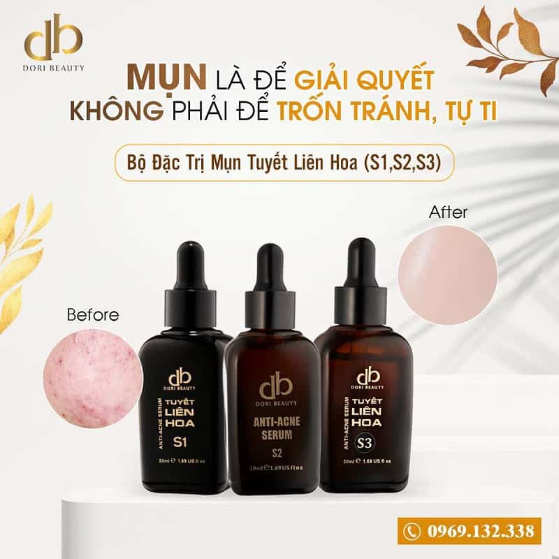 Mụn là để giải quyết - không phải để trốn tránh, tự ti.