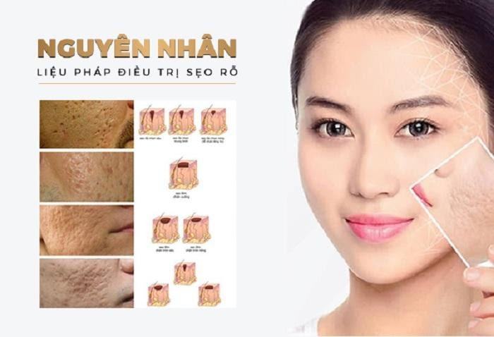 Địa chỉ trị sẹo rỗ mụn tại Long An