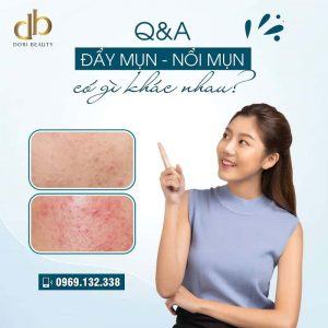 Nhân Mụn Đẩy Lên và Nổi Mụn Có Khác Nhau Không?