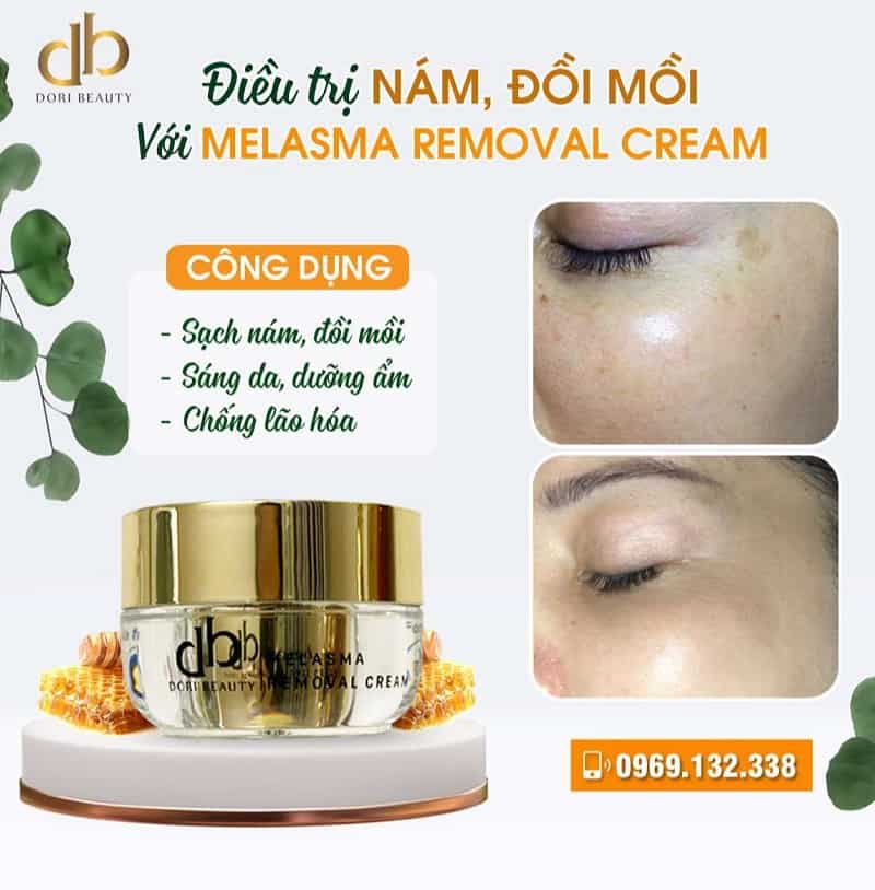 Hiệu quả điều trị nám, đồi mồi với melasma removal cream