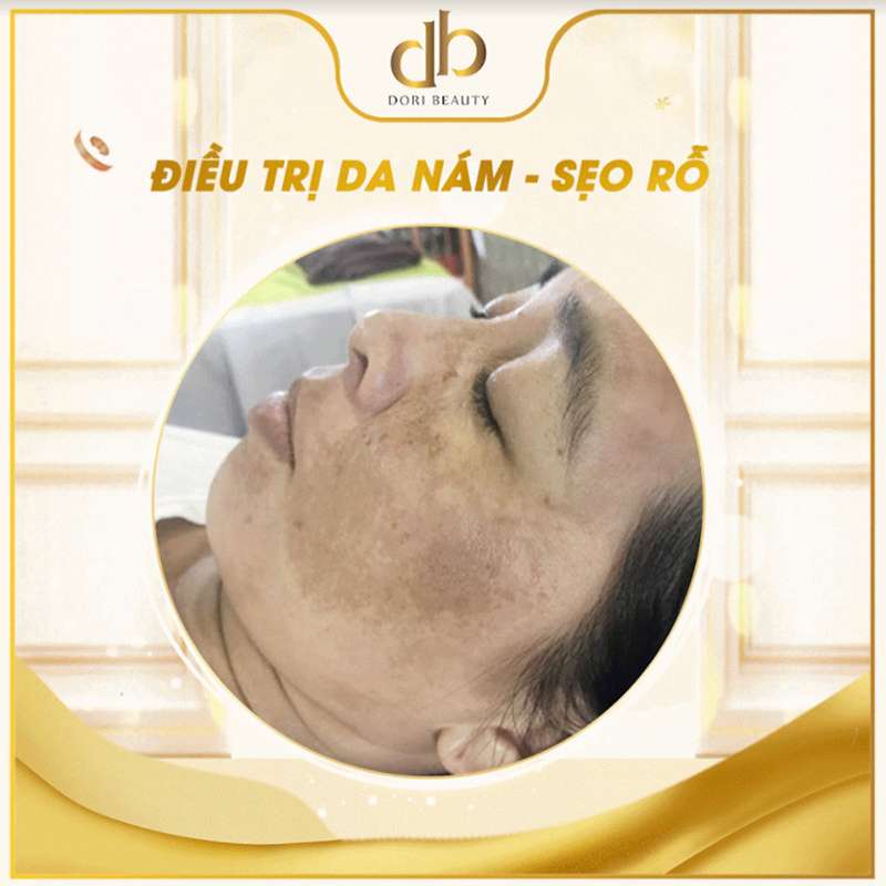 Điều trị da nám - sẹo rỗ