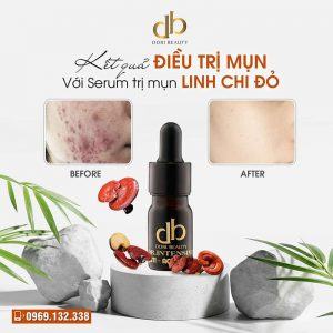 Hình Ảnh Kết Quả Trị Mụn Với Serum Linh Chi Đỏ DORI