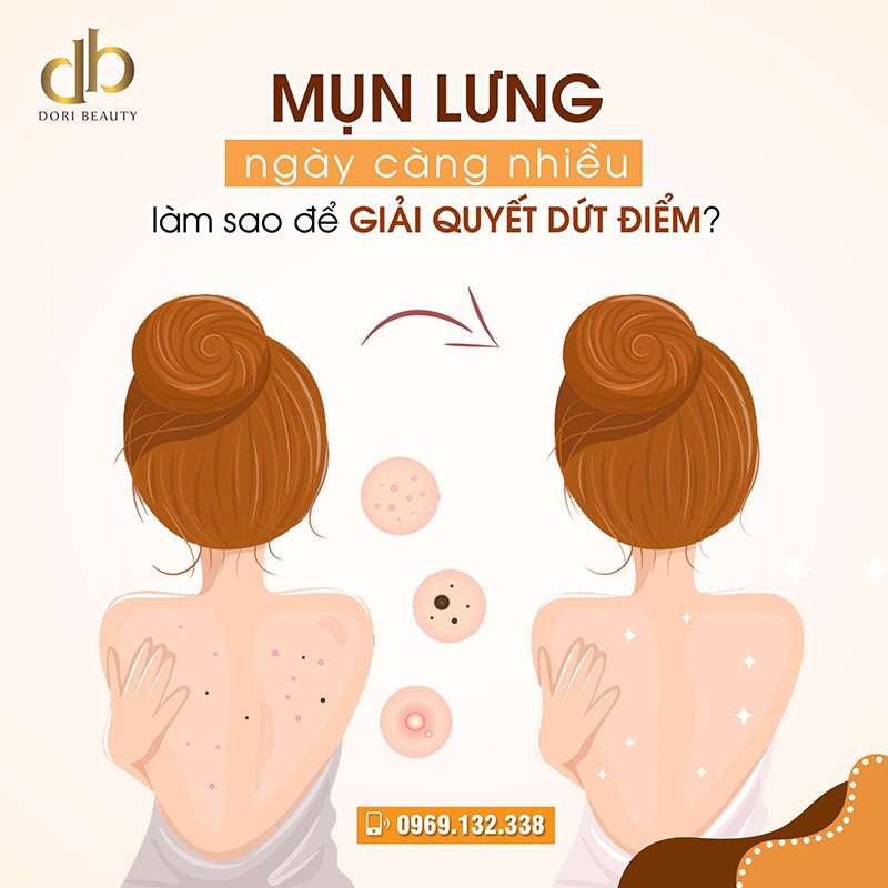 [Gấp] Làm Sao Để Trị Mụn Lưng Dứt Điểm