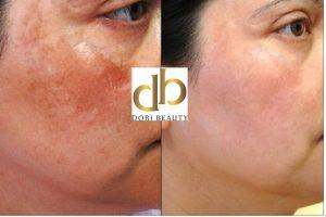 TOP địa chỉ trị nám - tàn nhang tại An Giang tốt uy tín nhất