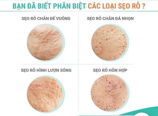 Các loại sẹo rỗ mụn phổ biến 