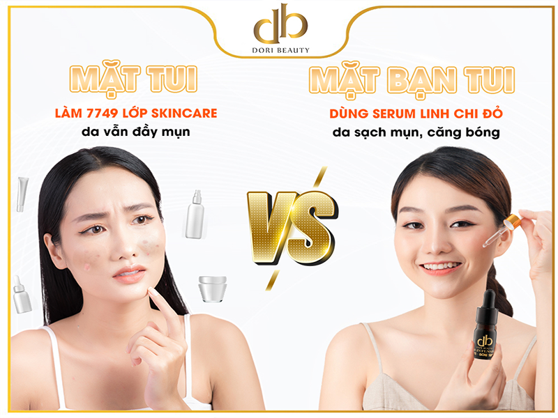 "Say Bye" Với Mụn Nhờ Serum Linh Chi Đỏ