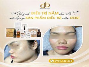 Hình Ảnh Trước & Sau Trị Nám Với Mỹ Phẩm DORI Của Chị T
